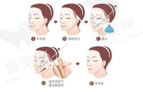 韩国Beulibal整形外科正规吗