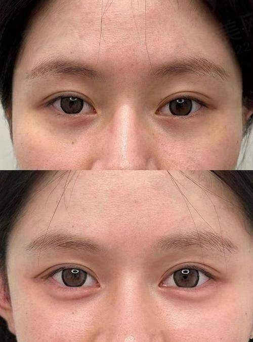 五、获取深圳福雅医疗美容门诊部卧蚕价格报价指引