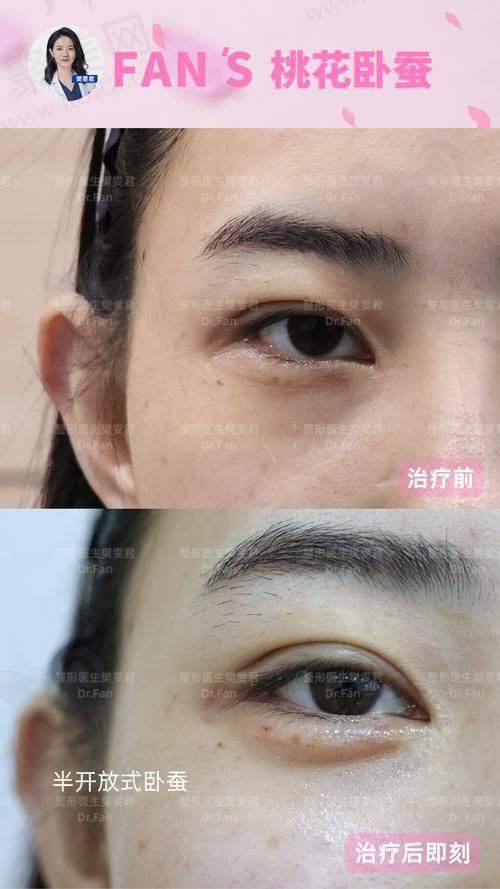 一、深圳福雅医疗美容门诊部卧蚕项目价格总览