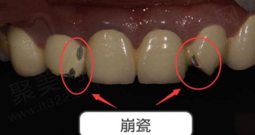 六、天津中牙口腔医院——吸附性义齿扛把子