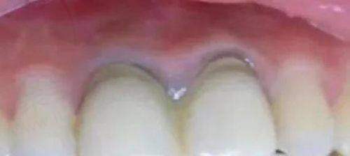 总的来说，选择适合的全瓷牙方案
