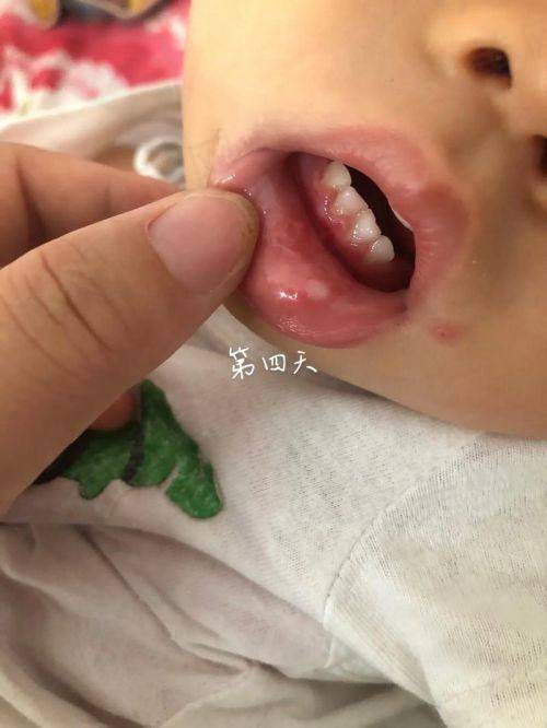 广州鼎植口腔治疗儿童牙龈炎，价格和医疗保险靠谱吗？