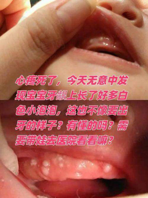 广州鼎植口腔治疗儿童牙龈炎，医疗团队靠谱吗？