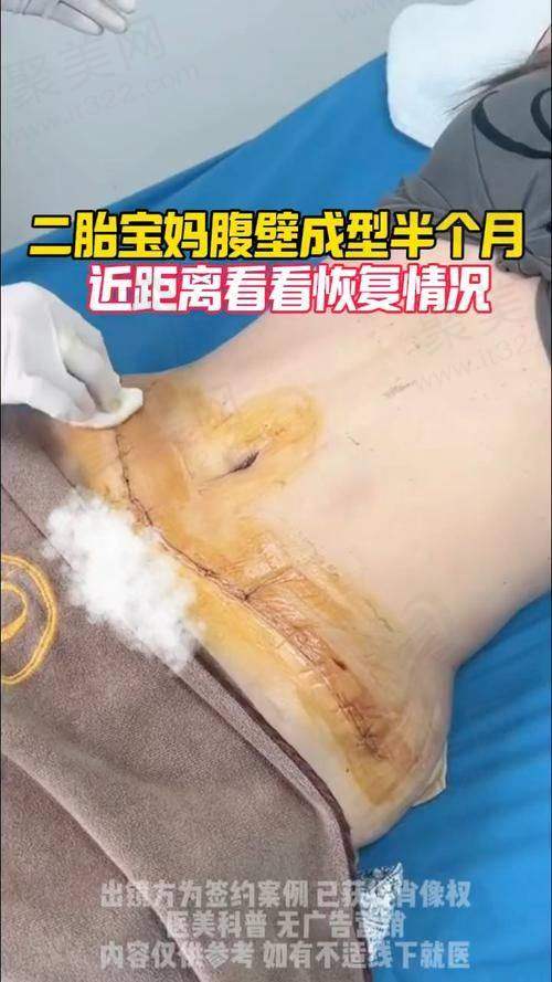 西安国医整形医院崔鑫医生腹壁成形手术怎么样？