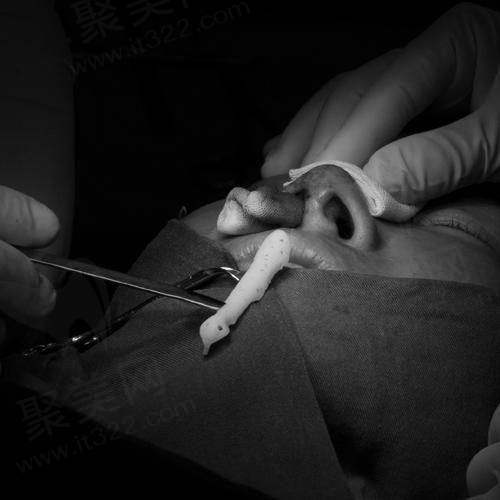 取鼻子假体几天能修复？假体隆鼻取出后恢复期、风险及费用详解，教你如何安全选择与避免陷阱