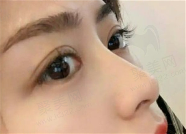深圳艺星医疗美容医院吕瑛真实评价如何？超万例眼整形经验获患者高度认可！ 
