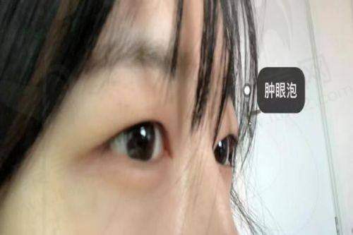 二、大连冯勇医生双眼皮修复技术优势