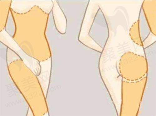 苏州圣爱整形医院更擅长什么之胸部整形？