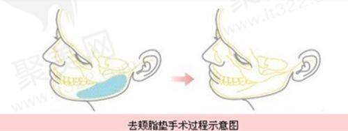 四、重庆当代整形医院隆胸医生 - 牙祖蒙