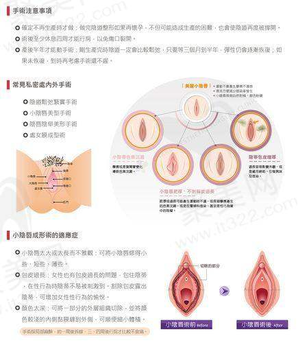 总结：3D生物束带紧缩术的长期有效性与选择