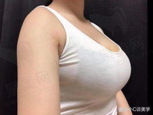南京黄名斗医生做自体脂肪填充好吗？了解他精湛技艺与成功案例助你变美无忧 