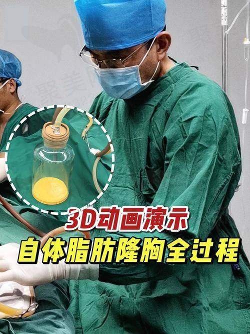 黄名斗医生自体脂肪填充的临床实例