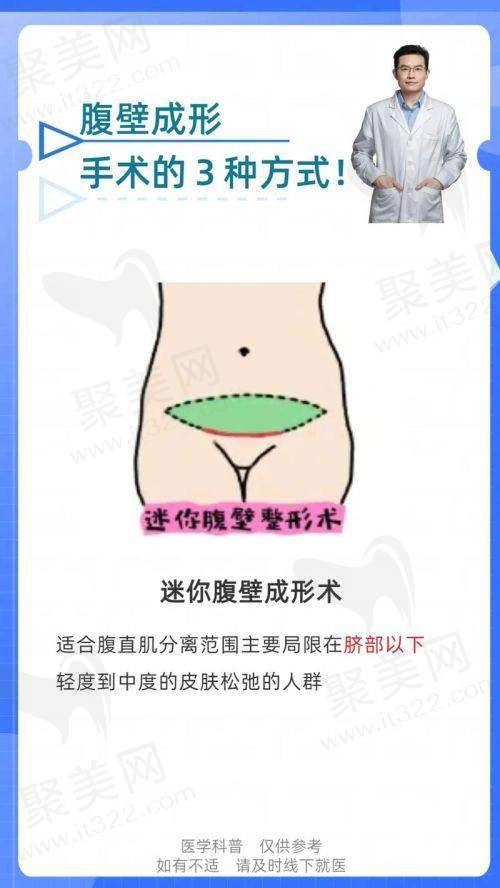 三、成都现代腹壁成形医院的手术方案与技术特色