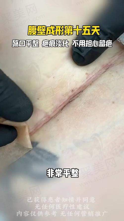 四、成都现代腹壁成形医院的收费情况