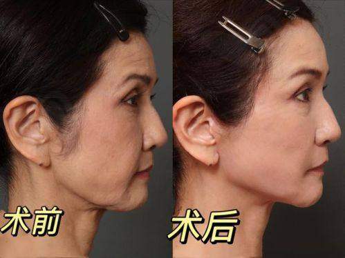 三、李建钢筋膜提升的优势