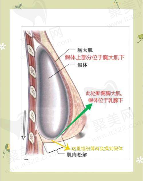 长沙祺美胸整形肖征刚曼托假体隆胸医院实力可靠