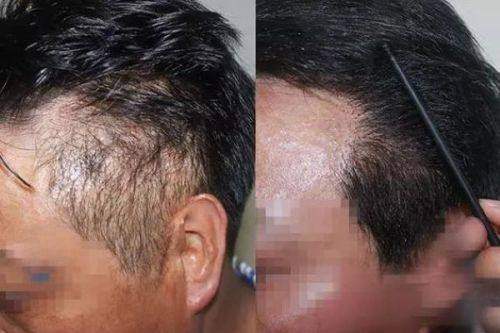 三、绍兴金柯桥医院植发科的多样技术优势明显