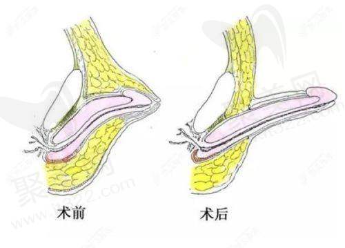 2025泰国其他变性手术项目价格(泰铢)