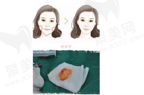 广州广大医院:专精医生助力唇腭裂治疗