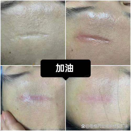 二、广州广大医院疤痕整形技术实力