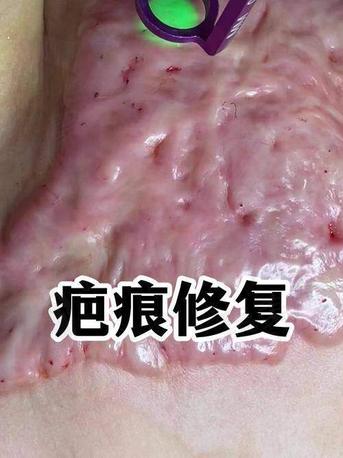 四、广州广大医院疤痕整形患者评价