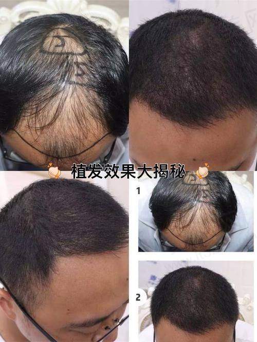 五、绍兴金柯桥医院植发科的便利与优惠特别实在