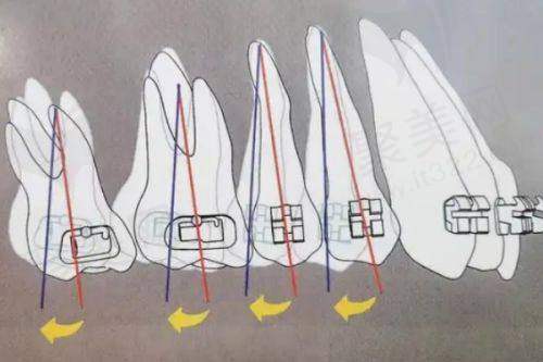 上海鼎植医生汪园做正畸怎么样?