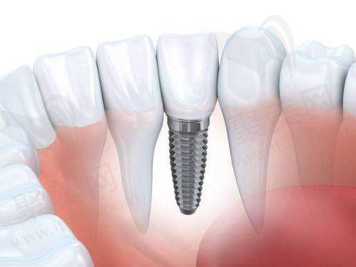 上海鼎植医生周建亭医生种植牙怎么样?