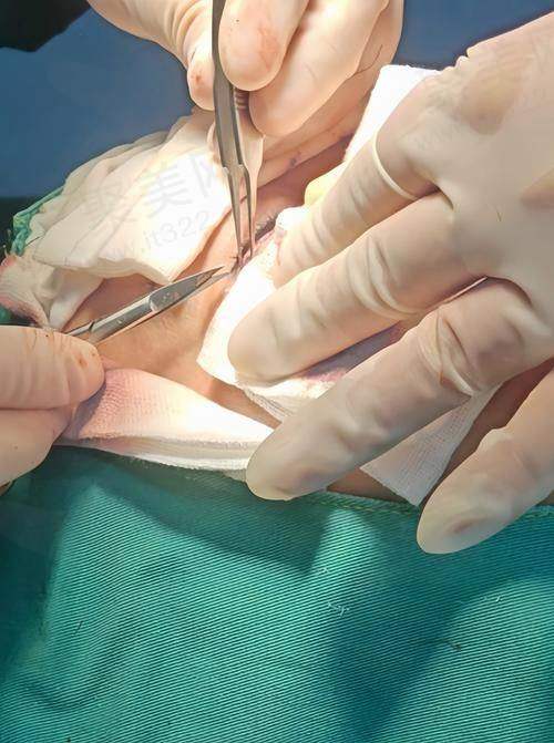 五、杜太超医生拉皮手术的价格