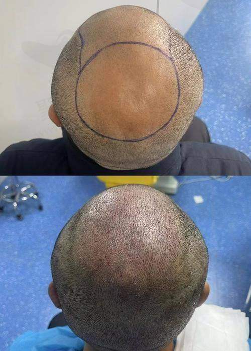 一、北京碧莲盛植发医生李嘉恒个人信息揭秘