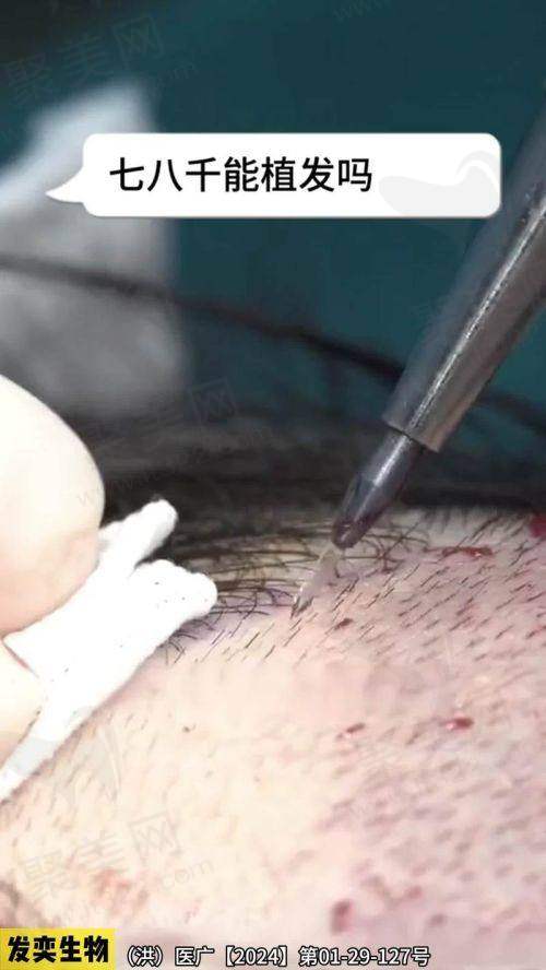 二、北京碧莲盛植发医生李嘉恒擅长项目剖析