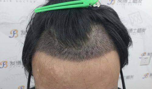 团队专精负责,保护手术质量