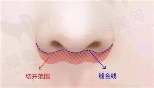 长沙颜华医疗美容门诊部：复合提缩术，防上唇外翻