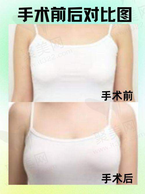 三、齐云香医生缩胸手术优势