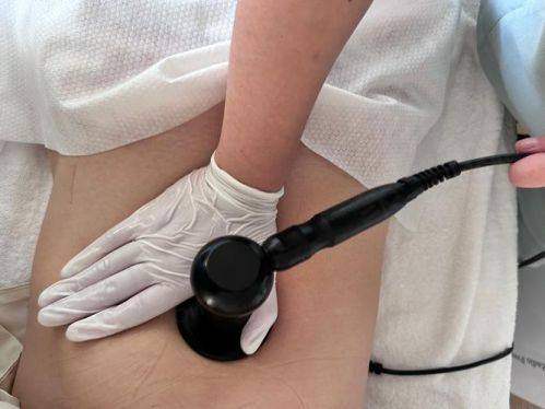 五、广州海峡整形医院——注重长期成效的腰腹环吸