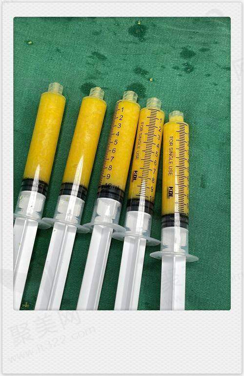 四、广州壹加壹整形医院——一对一个性化服务的腰腹环吸