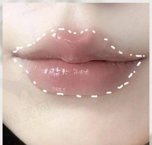 苏州圣爱整形医院注射塑形靠谱吗?技术团队是关键