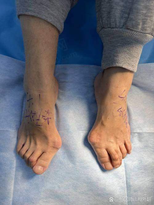 三、马文足科做大脚骨的技术优势