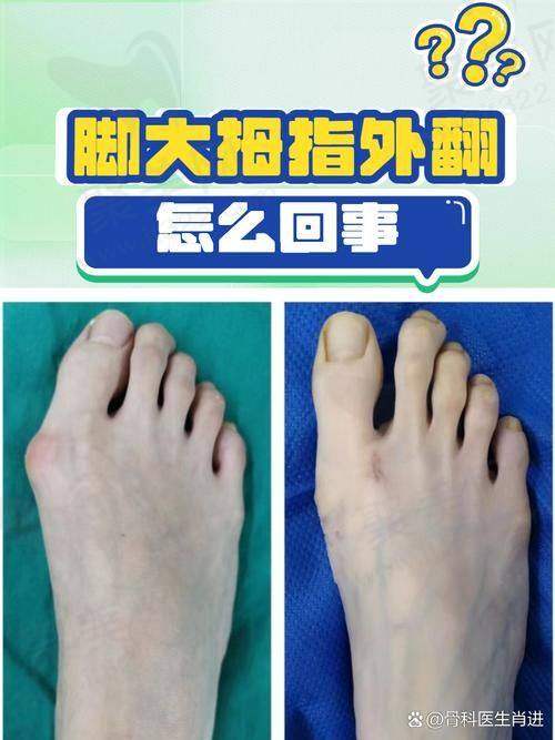 二、马文治疗大脚骨一般多少钱及影响因素