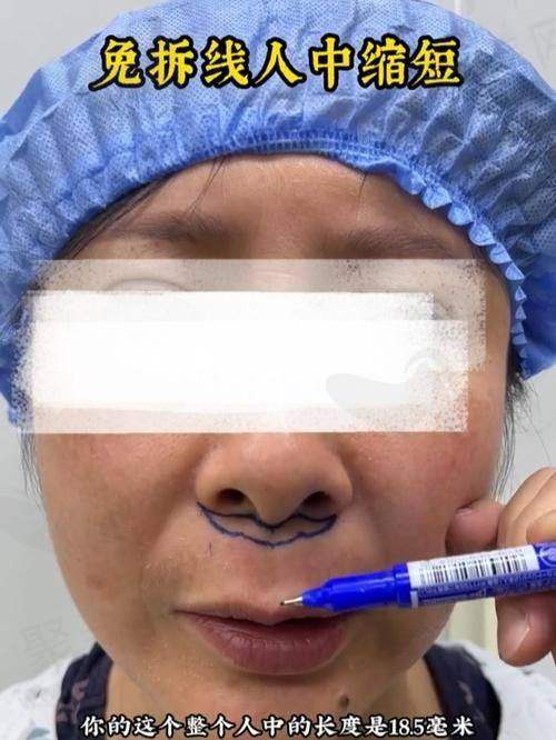 长沙美莱整形：技术精细，适合疤痕体质人群