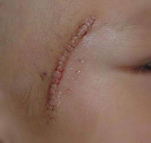 广州荔医医疗美容激光淡化胎记的技术优势