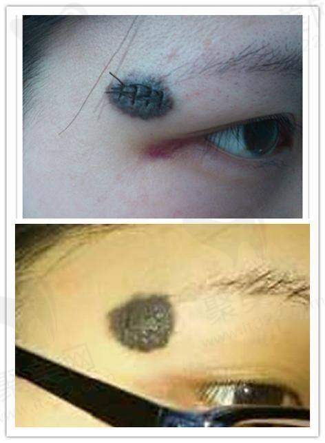 广州荔医医疗美容激光淡化胎记的适用人群广泛