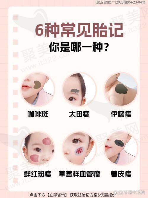 广州荔医医疗美容激光淡化胎记的作用显著