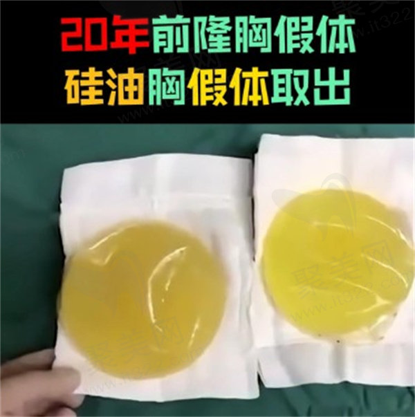 广州荔医齐云香医生乳房硅油取出原价13500元,优惠价格8080元起速来抢!